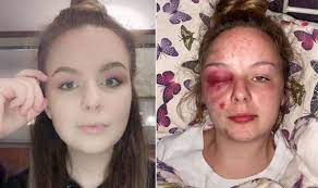 Eleanor Williams, 2 images of the girl side by side, one image of her normal self and other where she has inflicted injuries on her face